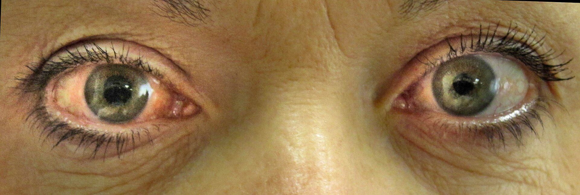 Acute_angle_closure_glaucoma_11zon.jpg