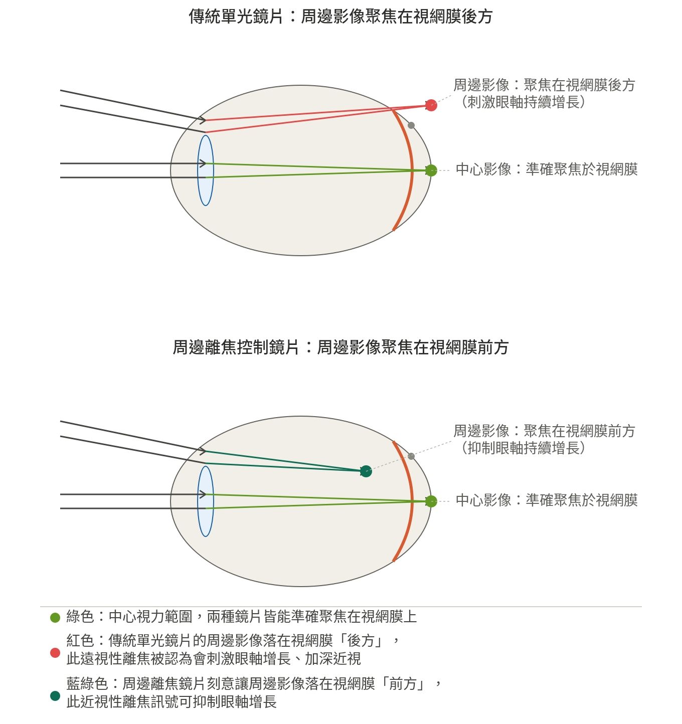 周邊離焦矯正近視原理圖.jpg